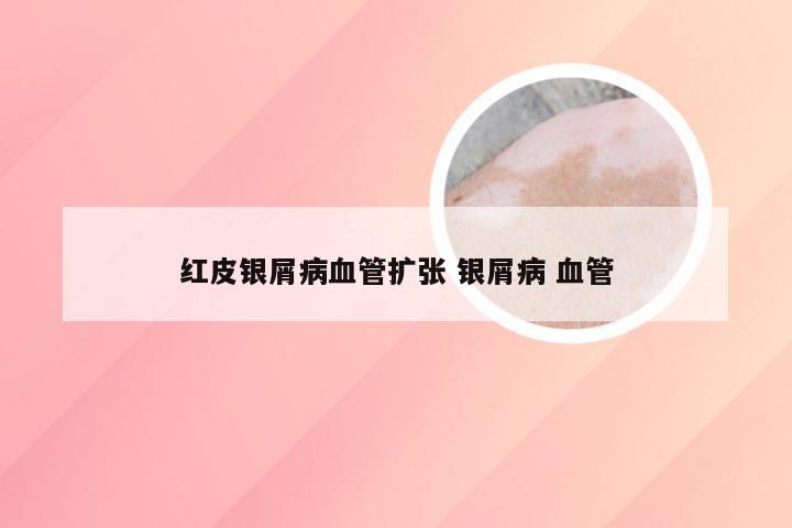 红皮银屑病血管扩张 银屑病 血管