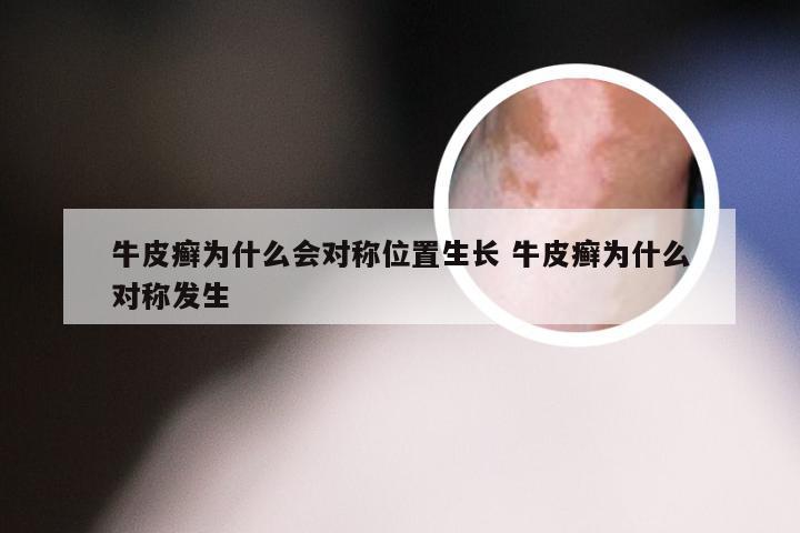 牛皮癣为什么会对称位置生长 牛皮癣为什么对称发生
