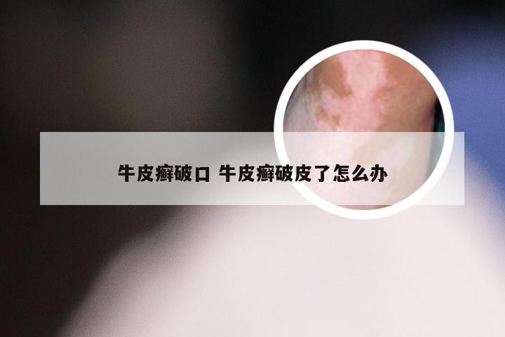 牛皮癣破口 牛皮癣破皮了怎么办
