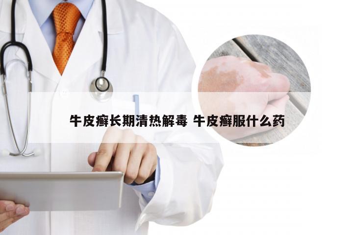 牛皮癣长期清热解毒 牛皮癣服什么药