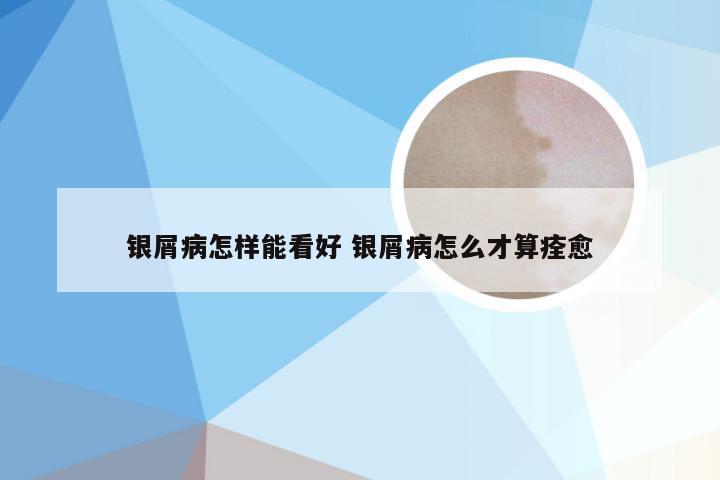 银屑病怎样能看好 银屑病怎么才算痊愈