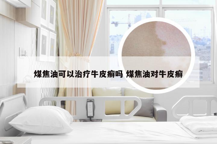 煤焦油可以治疗牛皮癣吗 煤焦油对牛皮癣