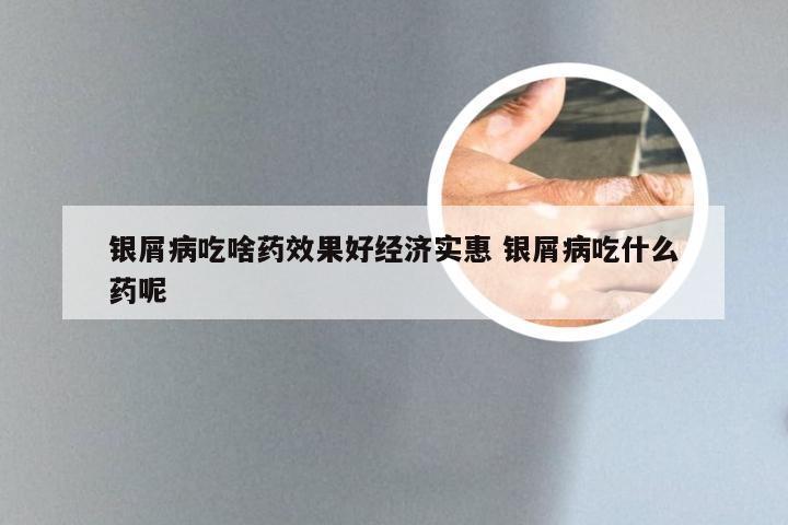 银屑病吃啥药效果好经济实惠 银屑病吃什么药呢