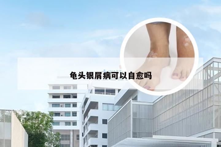 龟头银屑病可以自愈吗