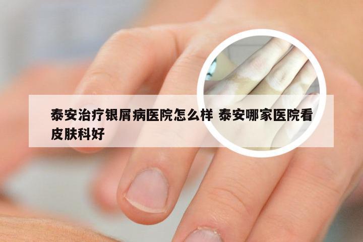 泰安治疗银屑病医院怎么样 泰安哪家医院看皮肤科好
