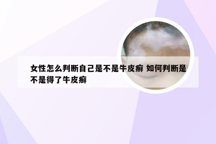 女性怎么判断自己是不是牛皮癣 如何判断是不是得了牛皮癣