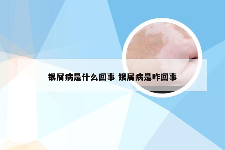 银屑病是什么回事 银屑病是咋回事