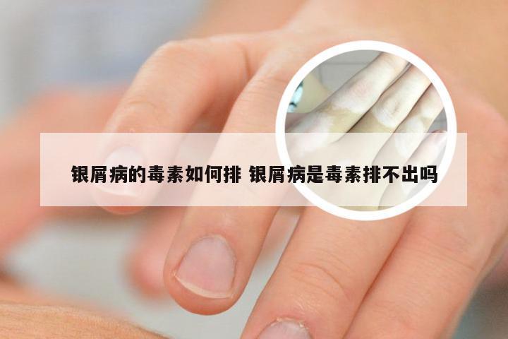 银屑病的毒素如何排 银屑病是毒素排不出吗