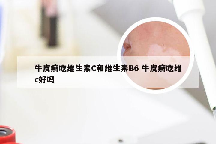 牛皮癣吃维生素C和维生素B6 牛皮癣吃维c好吗