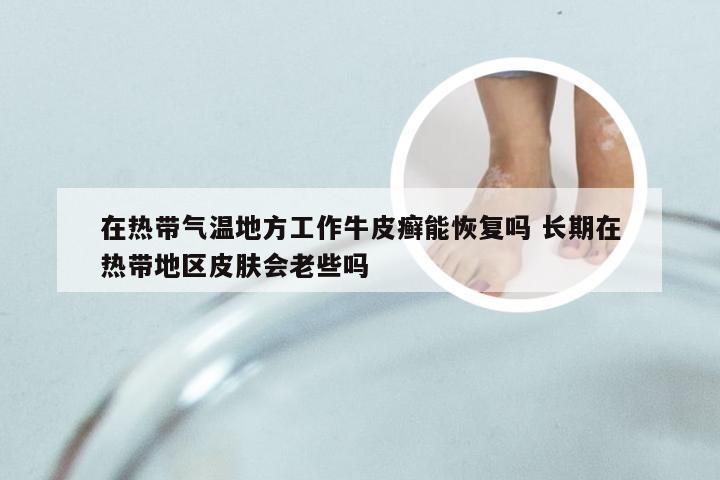 在热带气温地方工作牛皮癣能恢复吗 长期在热带地区皮肤会老些吗