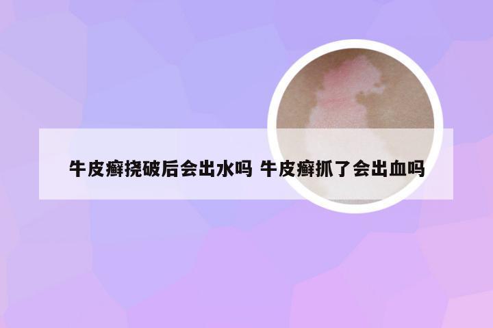 牛皮癣挠破后会出水吗 牛皮癣抓了会出血吗