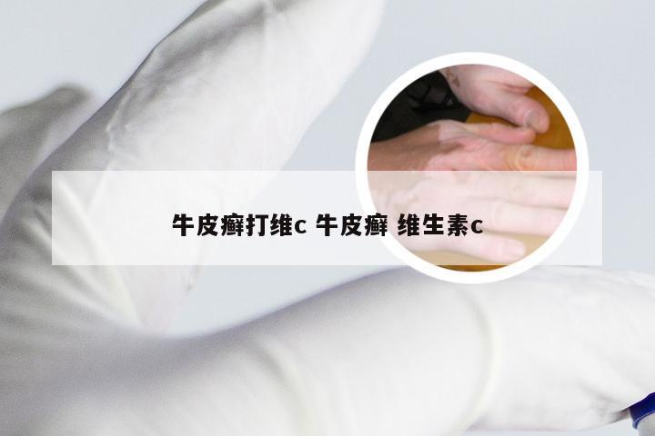 牛皮癣打维c 牛皮癣 维生素c