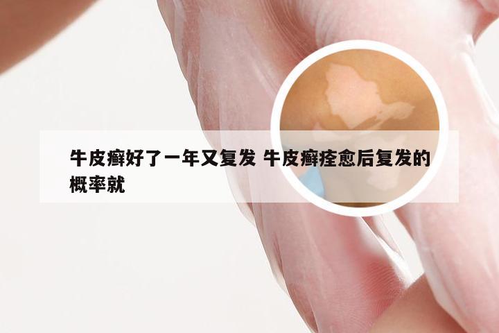 牛皮癣好了一年又复发 牛皮癣痊愈后复发的概率就
