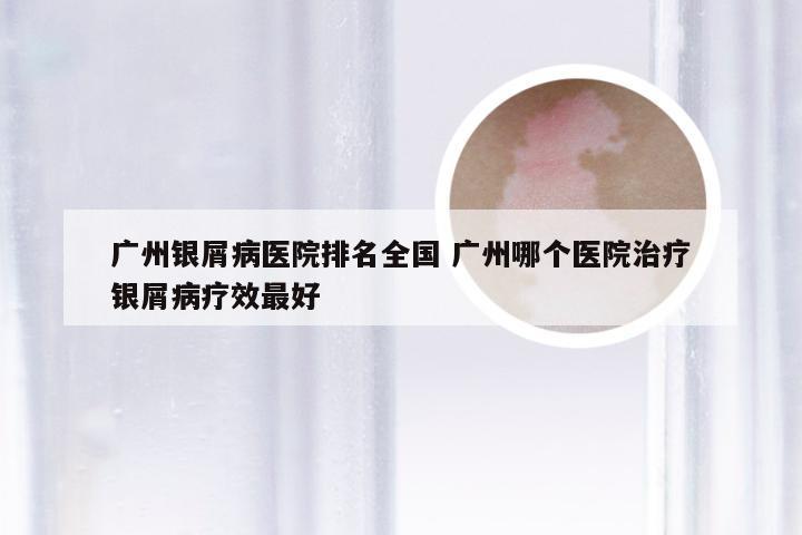 广州银屑病医院排名全国 广州哪个医院治疗银屑病疗效最好