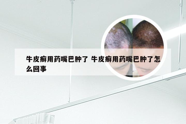 牛皮癣用药嘴巴肿了 牛皮癣用药嘴巴肿了怎么回事