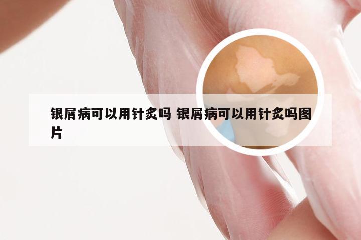 银屑病可以用针炙吗 银屑病可以用针炙吗图片