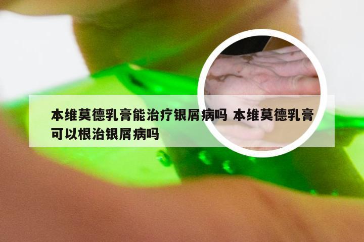 本维莫德乳膏能治疗银屑病吗 本维莫德乳膏可以根治银屑病吗