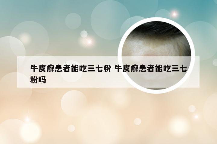牛皮癣患者能吃三七粉 牛皮癣患者能吃三七粉吗