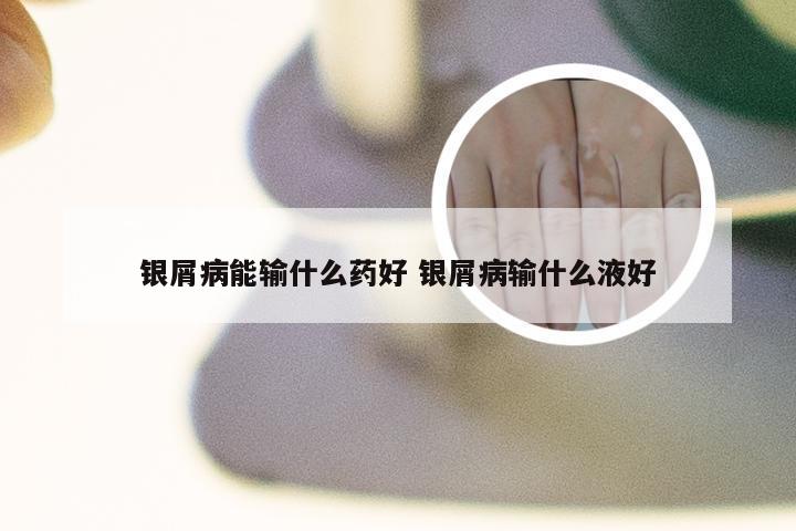 银屑病能输什么药好 银屑病输什么液好