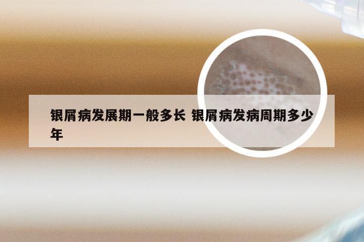 银屑病发展期一般多长 银屑病发病周期多少年
