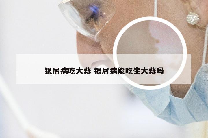 银屑病吃大蒜 银屑病能吃生大蒜吗