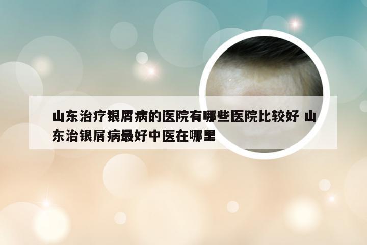山东治疗银屑病的医院有哪些医院比较好 山东治银屑病最好中医在哪里