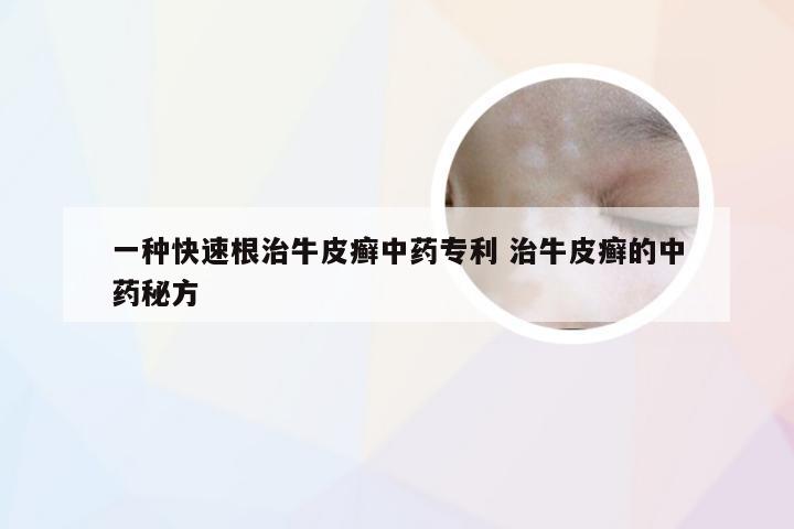 一种快速根治牛皮癣中药专利 治牛皮癣的中药秘方