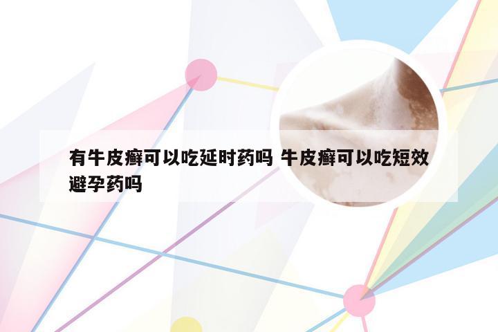 有牛皮癣可以吃延时药吗 牛皮癣可以吃短效避孕药吗
