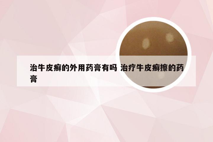治牛皮癣的外用药膏有吗 治疗牛皮癣擦的药膏