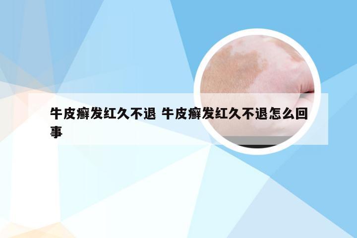 牛皮癣发红久不退 牛皮癣发红久不退怎么回事
