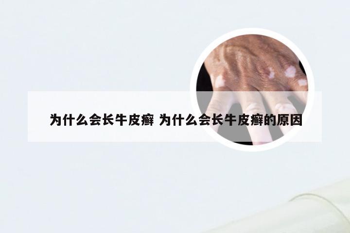 为什么会长牛皮癣 为什么会长牛皮癣的原因