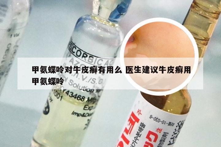 甲氨蝶呤对牛皮癣有用么 医生建议牛皮癣用甲氨蝶呤