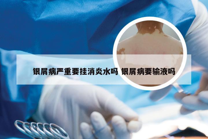 银屑病严重要挂消炎水吗 银屑病要输液吗