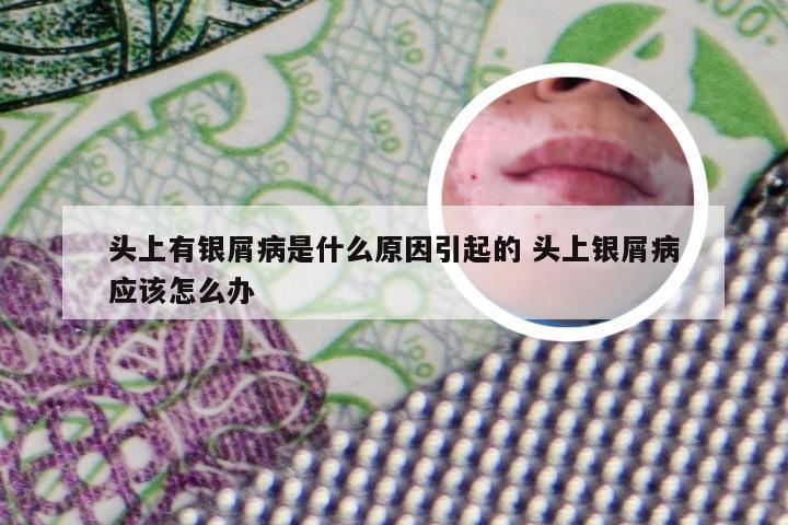 头上有银屑病是什么原因引起的 头上银屑病应该怎么办