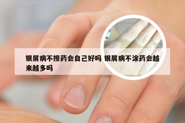 银屑病不擦药会自己好吗 银屑病不涂药会越来越多吗