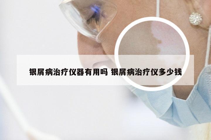 银屑病治疗仪器有用吗 银屑病治疗仪多少钱