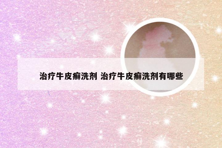 治疗牛皮癣洗剂 治疗牛皮癣洗剂有哪些
