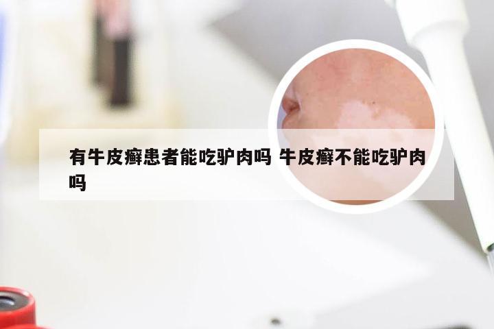 有牛皮癣患者能吃驴肉吗 牛皮癣不能吃驴肉吗