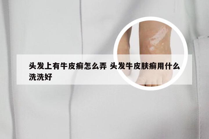 头发上有牛皮癣怎么弄 头发牛皮肤癣用什么洗洗好