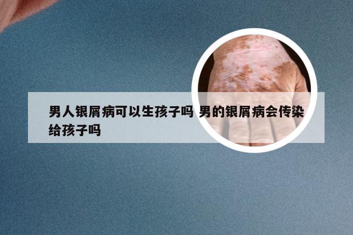 男人银屑病可以生孩子吗 男的银屑病会传染给孩子吗