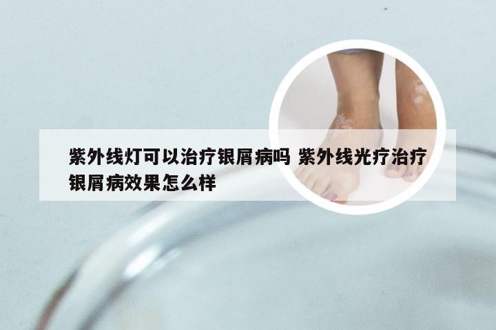 紫外线灯可以治疗银屑病吗 紫外线光疗治疗银屑病效果怎么样
