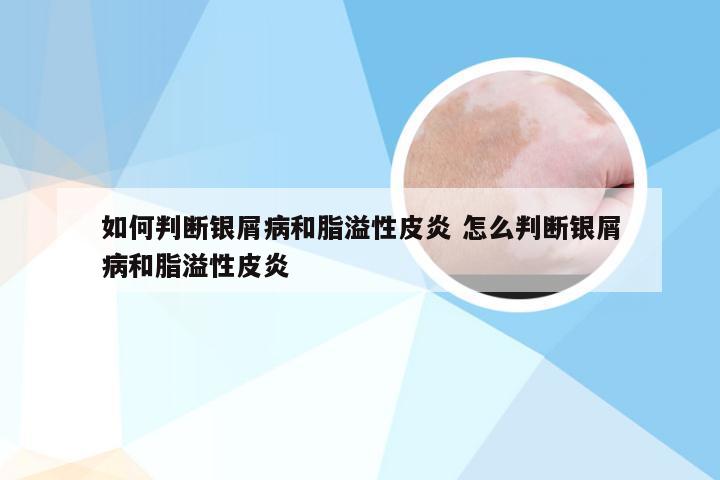 如何判断银屑病和脂溢性皮炎 怎么判断银屑病和脂溢性皮炎