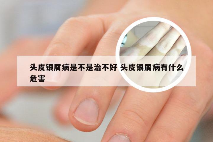 头皮银屑病是不是治不好 头皮银屑病有什么危害