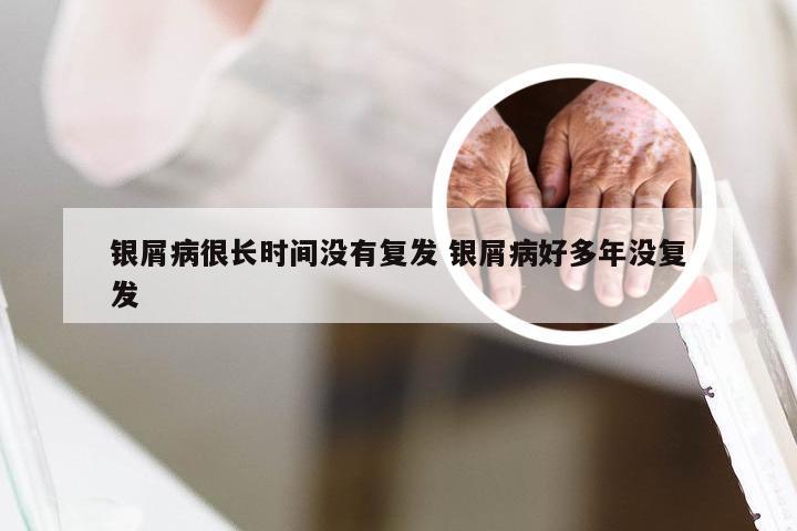 银屑病很长时间没有复发 银屑病好多年没复发