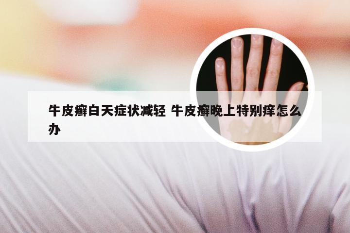 牛皮癣白天症状减轻 牛皮癣晚上特别痒怎么办