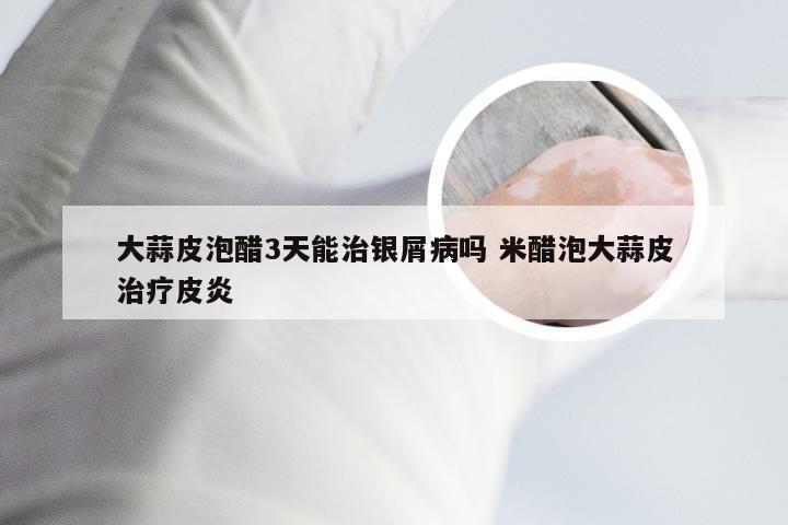 大蒜皮泡醋3天能治银屑病吗 米醋泡大蒜皮治疗皮炎