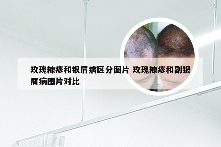 玫瑰糠疹和银屑病区分图片 玫瑰糠疹和副银屑病图片对比