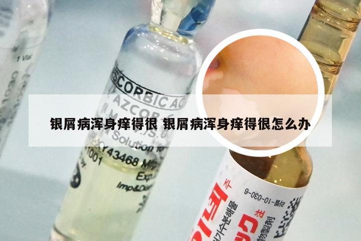 银屑病浑身痒得很 银屑病浑身痒得很怎么办