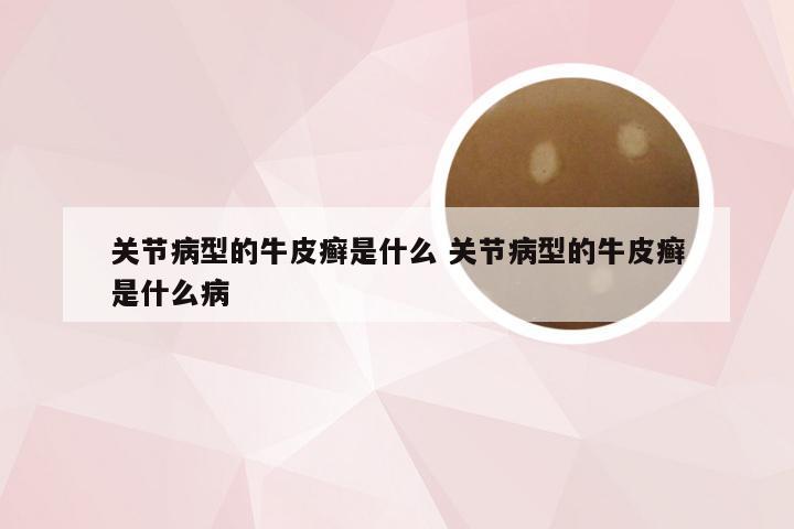 关节病型的牛皮癣是什么 关节病型的牛皮癣是什么病