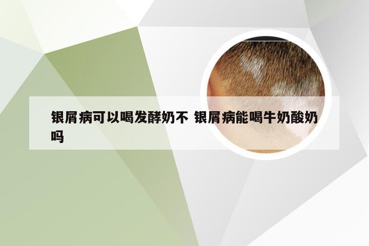 银屑病可以喝发酵奶不 银屑病能喝牛奶酸奶吗